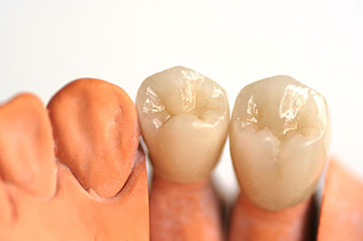 Dental Crowns 91601